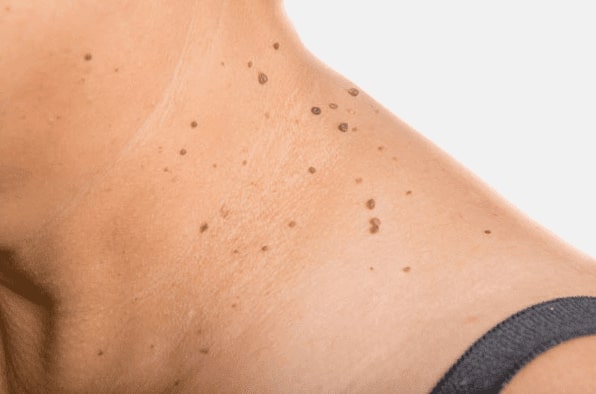 Are you looking for easy skin tag removal Renfrew - then contact Spire today!