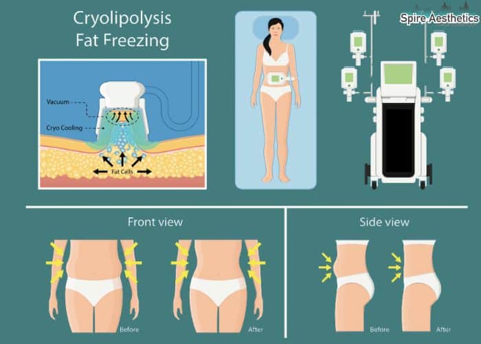 Image of diet and fat freezing combined for best results for Spire Aesthetics Renfrew