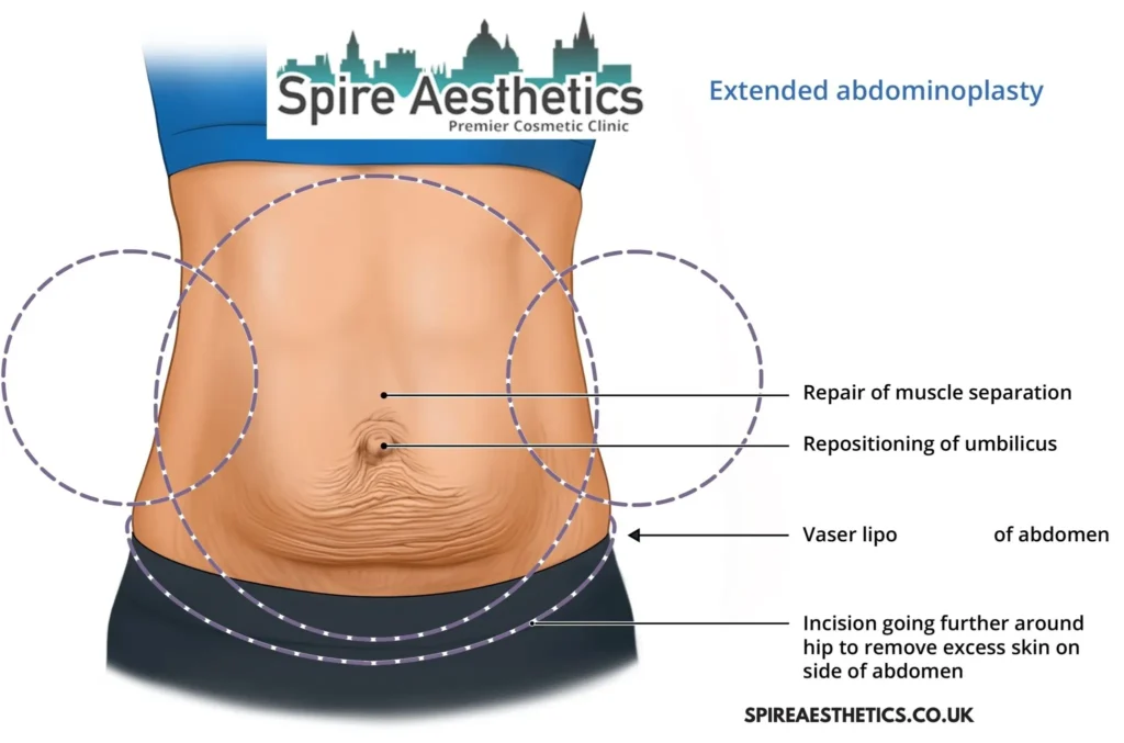 Understanding Loose Skin After Gastric Band Renfrew Surgery and HIFU Treatment