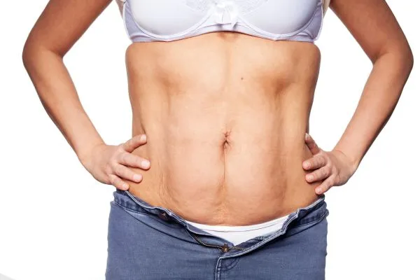 sagging skin on woman's stomach after weight loss injections Renfrew