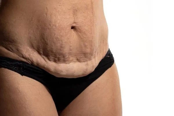 Image of womans stomach after weight loss injections Renfrew showing saggy skin