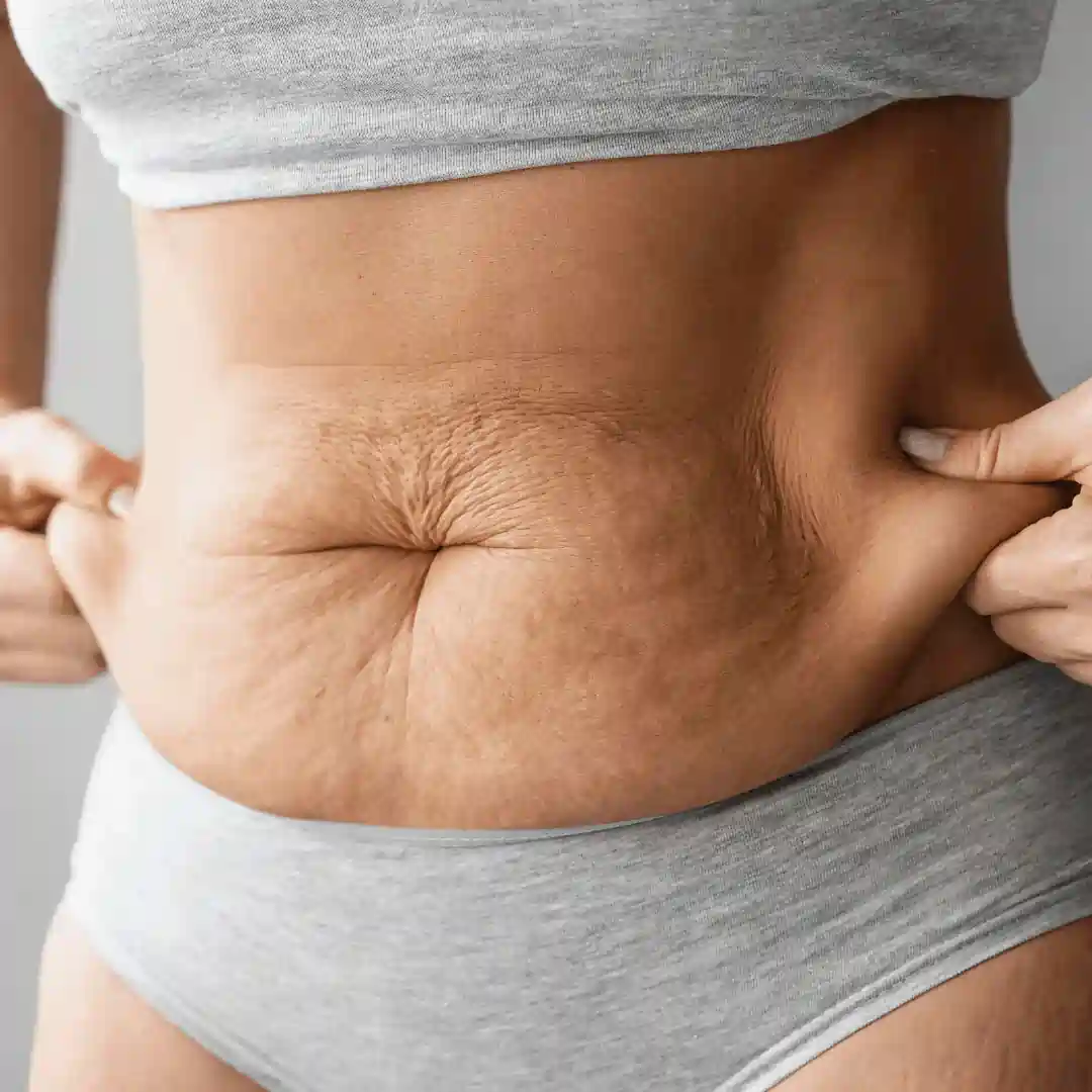 Is It Normal to Have Loose Skin After Pregnancy Renfrew?